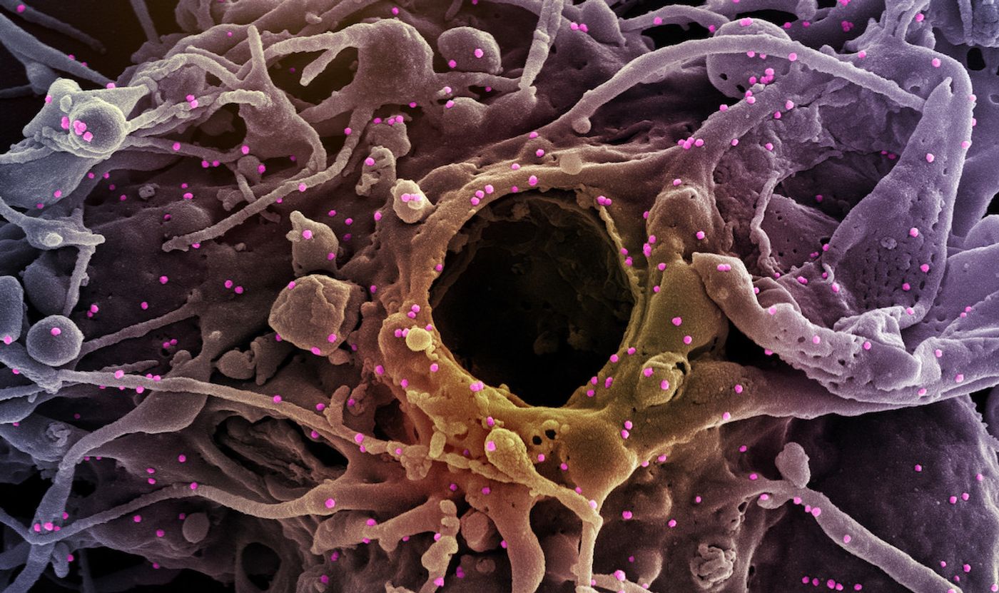 Colorized scanning electron micrograph of a cell (purple) infected with UK B.1.1.7 variant SARS-CoV-2 virus particles (pink), isolated from a patient sample. Image captured at the NIAID Integrated Research Facility (IRF) in Fort Detrick, Maryland. Credit: NIAID