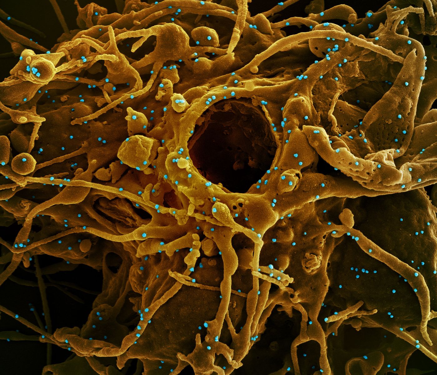 Colorized scanning electron micrograph of a cell (gold) infected with a variant of SARS-CoV-2 virus particles (blue), isolated from a patient sample. Image captured at the NIAID Integrated Research Facility (IRF) in Fort Detrick, Maryland. Credit: NIAID