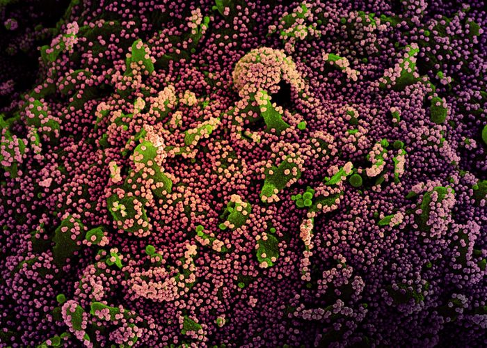 Colorized scanning electron micrograph of a cell (green) heavily infected with SARS-CoV-2 virus particles (purple), isolated from a patient sample. Image captured at the NIAID Integrated Research Facility (IRF) in Fort Detrick, Maryland. / Credit: NIAID 
