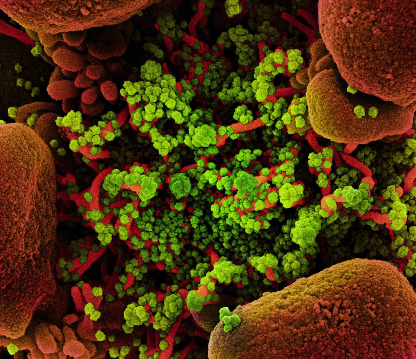 Colorized scanning electron micrograph of an apoptotic cell (red) heavily infected with SARS-CoV-2 virus particles (green), isolated from a patient sample. Image captured at the NIAID Integrated Research Facility (IRF) in Fort Detrick, Maryland./ Credit: NIAID