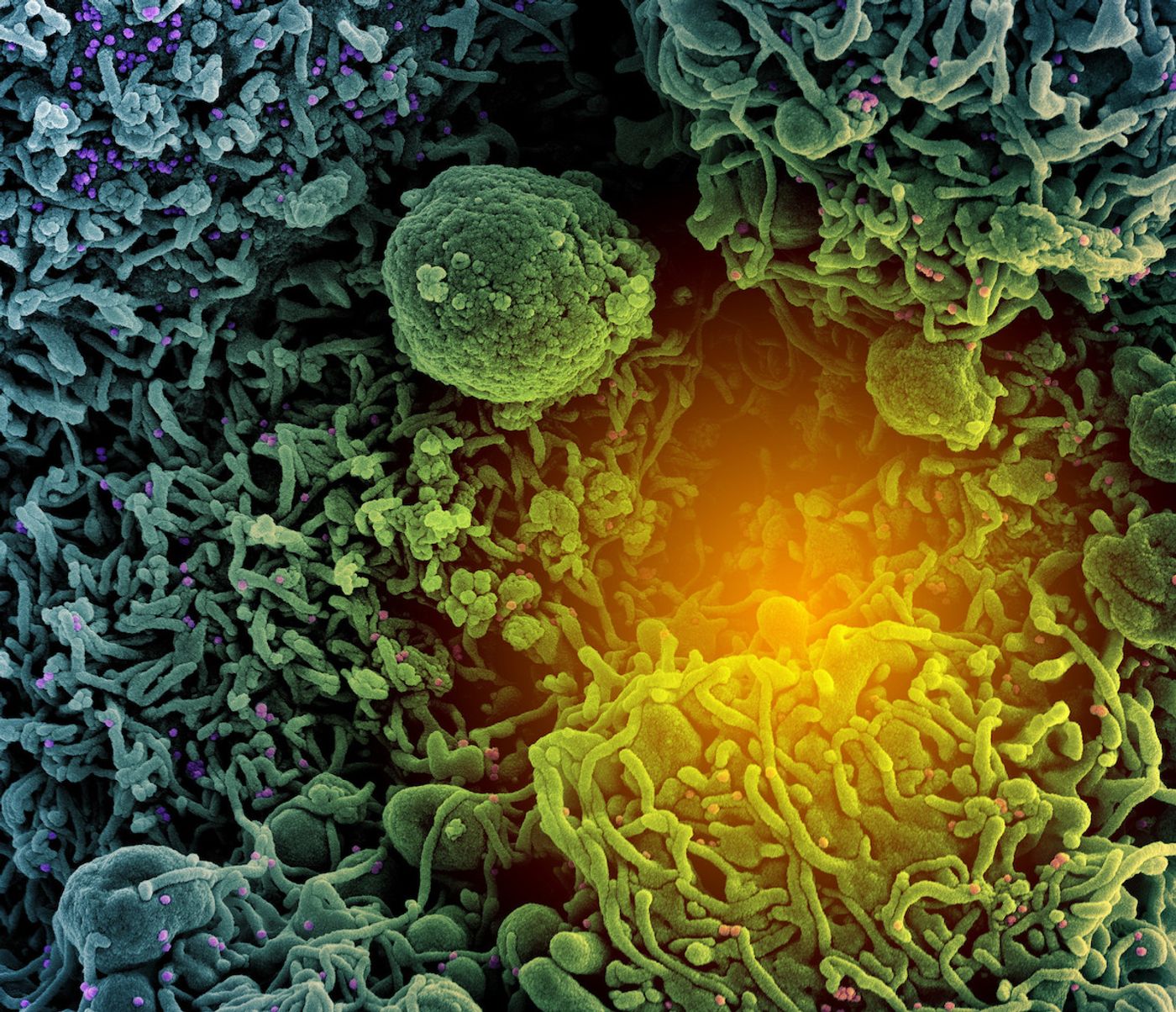 Colorized scanning electron micrograph of a cell (teal and green) infected with SARS-CoV-2 virus particles (purple and pink), isolated from a patient sample. Image captured at the NIAID Integrated Research Facility (IRF) in Fort Detrick, Maryland. Credit: NIAID