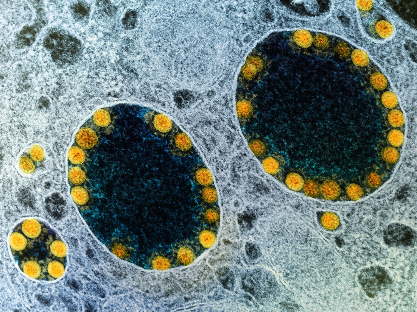 Transmission electron micrograph of SARS-CoV-2 virus particles (yellow) within endosomes of a heavily infected nasal Olfactory Epithelial Cell. Image captured at the NIAID Integrated Research Facility (IRF) in Fort Detrick, Maryland. Credit: NIAID