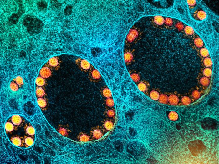 严重感染的鼻嗅上皮细胞内核内体中SARS-CoV-2病毒颗粒(金)的透射电镜图图片摄于马里兰州德特里克堡的美国国家卫生与发展研究所综合研究设施(IRF)。信贷:NIAID