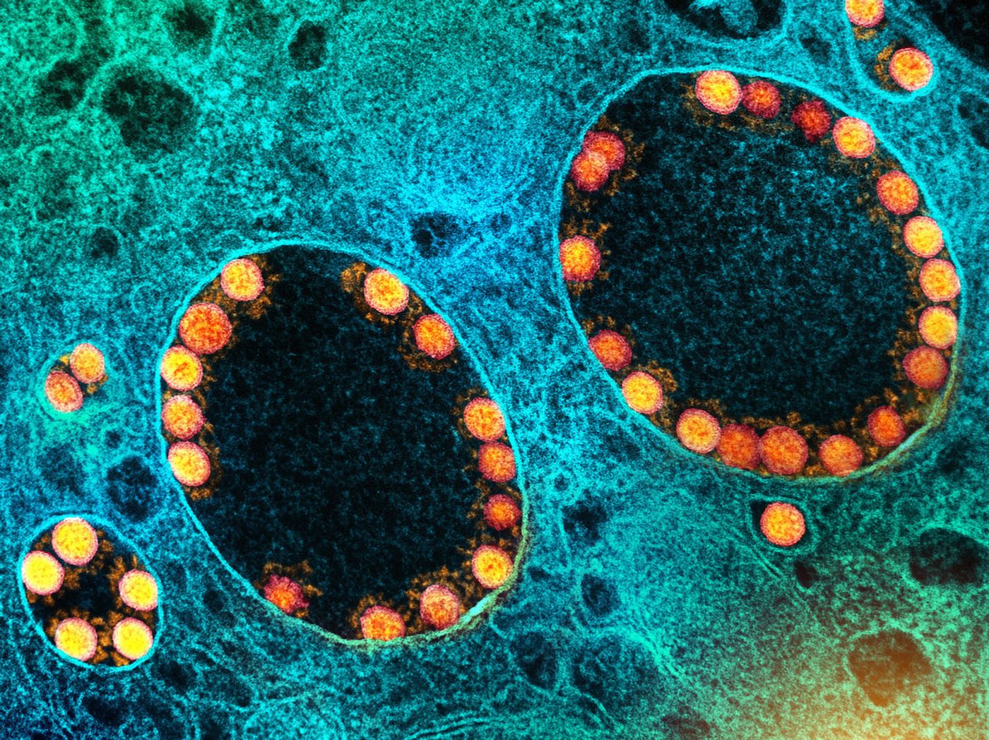 Transmission electron micrograph of SARS-CoV-2 virus particles (gold) within endosomes of a heavily infected nasal Olfactory Epithelial Cell. Image captured at the NIAID Integrated Research Facility (IRF) in Fort Detrick, Maryland. Credit: NIAID