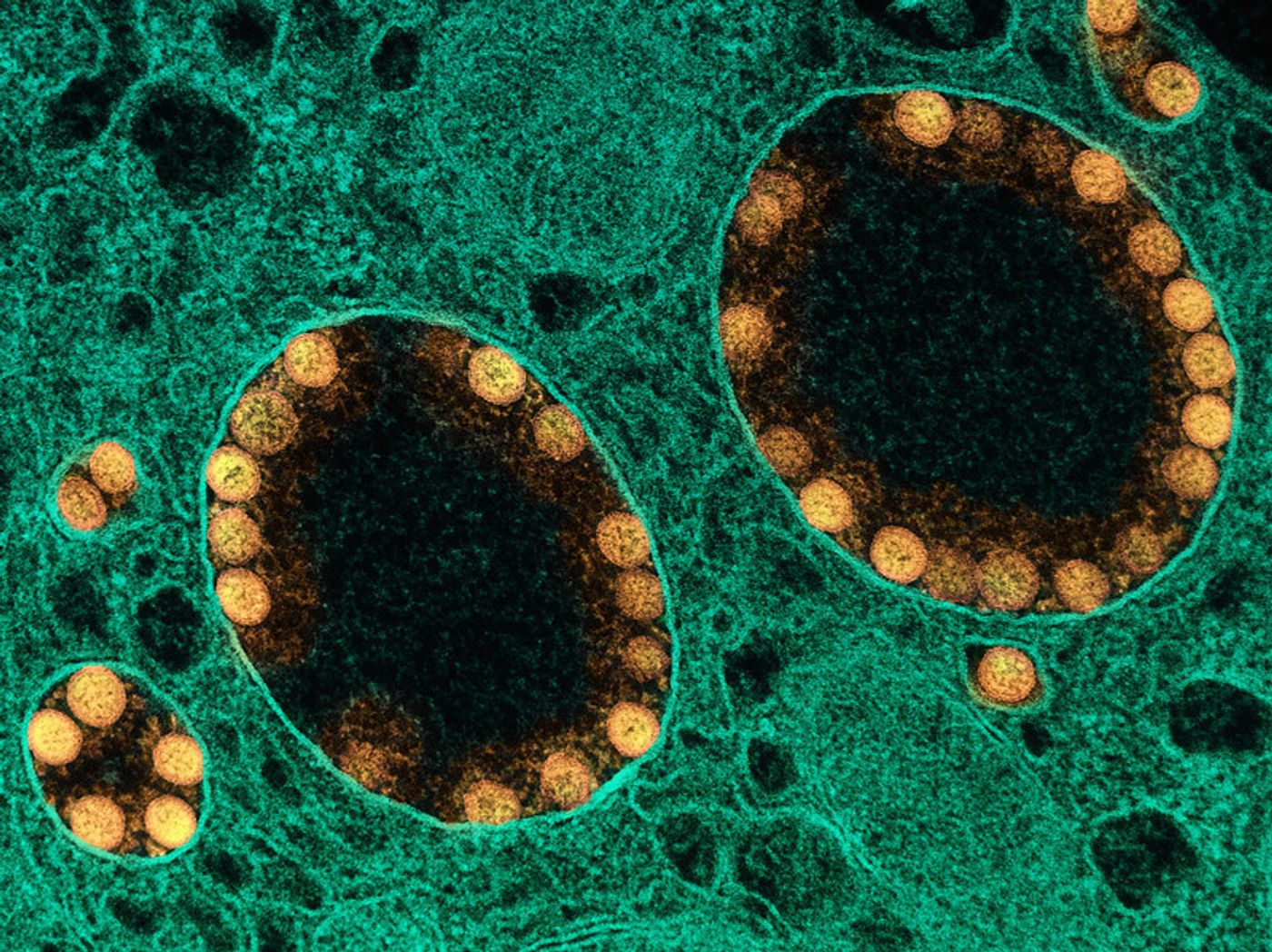Transmission electron micrograph of SARS-CoV-2 virus particles (gold) within endosomes of a heavily infected nasal Olfactory Epithelial Cell. Image captured at the NIAID Integrated Research Facility (IRF) in Fort Detrick, Maryland. Credit: NIAID