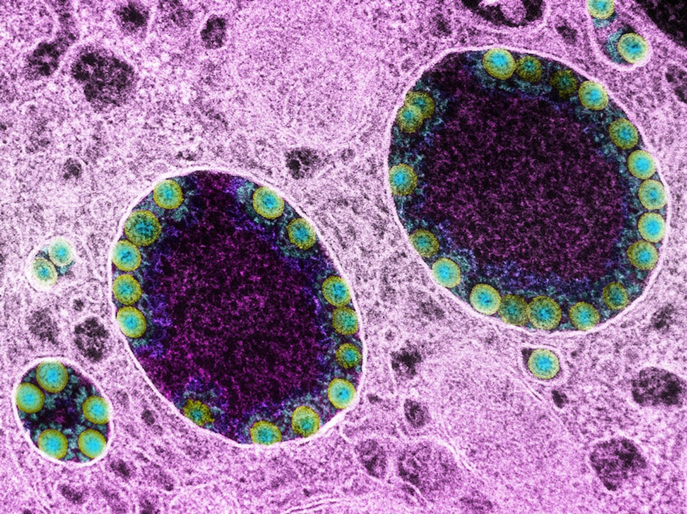 Transmission electron micrograph of SARS-CoV-2 virus particles (green) within endosomes of a heavily infected nasal Olfactory Epithelial Cell. Image captured at the NIAID Integrated Research Facility (IRF) in Fort Detrick, Maryland. / Credit: NIAID