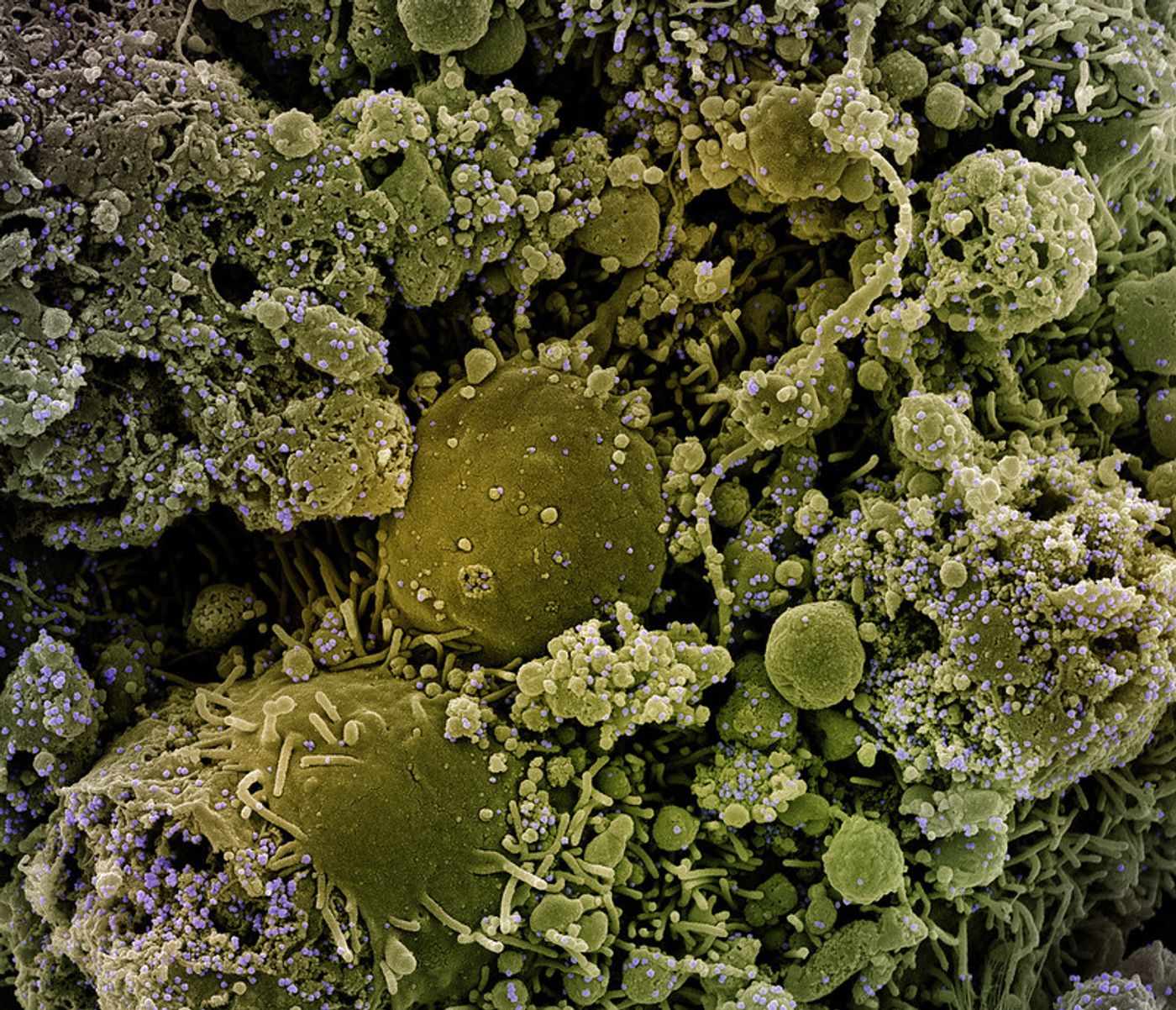 Colorized scanning electron micrograph of chronically infected and partially lysed cells (olive green) infected with a variant strain of SARS-CoV-2 virus particles (purple), isolated from a patient sample. Image captured at the NIAID Integrated Research Facility (IRF) in Fort Detrick, Maryland. Credit: NIAID