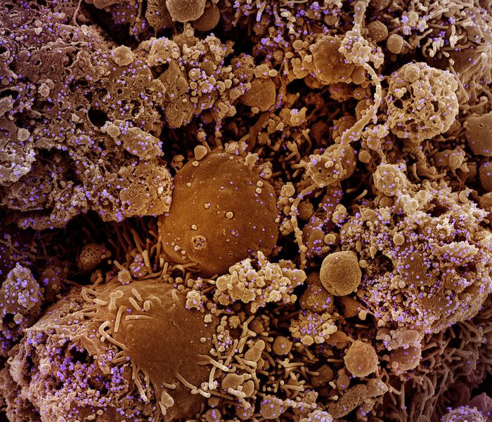 Colorized scanning electron micrograph of chronically infected and partially lysed cells (brown) infected with a variant strain of SARS-CoV-2 virus particles (purple), isolated from a patient sample. Image captured at the NIAID Integrated Research Facility (IRF) in Fort Detrick, Maryland. Credit: NIAID. 