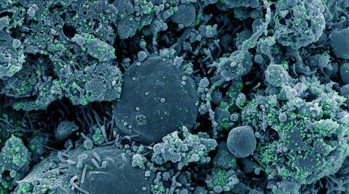 Cropped from Colorized scanning electron micrograph of chronically infected and partially lysed cells (blue) infected with a variant strain of SARS-CoV-2 virus particles (green), isolated from a patient sample. Image captured at the NIAID Integrated Research Facility (IRF) in Fort Detrick, Maryland. / Credit: NIAID
