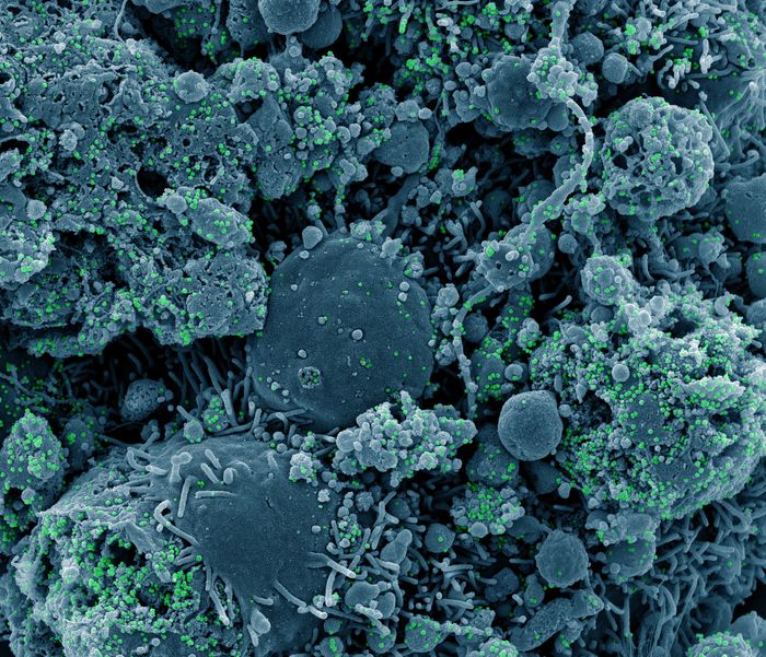 从患者样本中分离的慢性感染和部分裂解细胞(蓝色)感染SARS-CoV-2变异株病毒颗粒(绿色)的彩色扫描电子显微镜图。图片摄于马里兰州德特里克堡的美国国家卫生与发展研究所综合研究设施(IRF)。/信贷:NIAID
