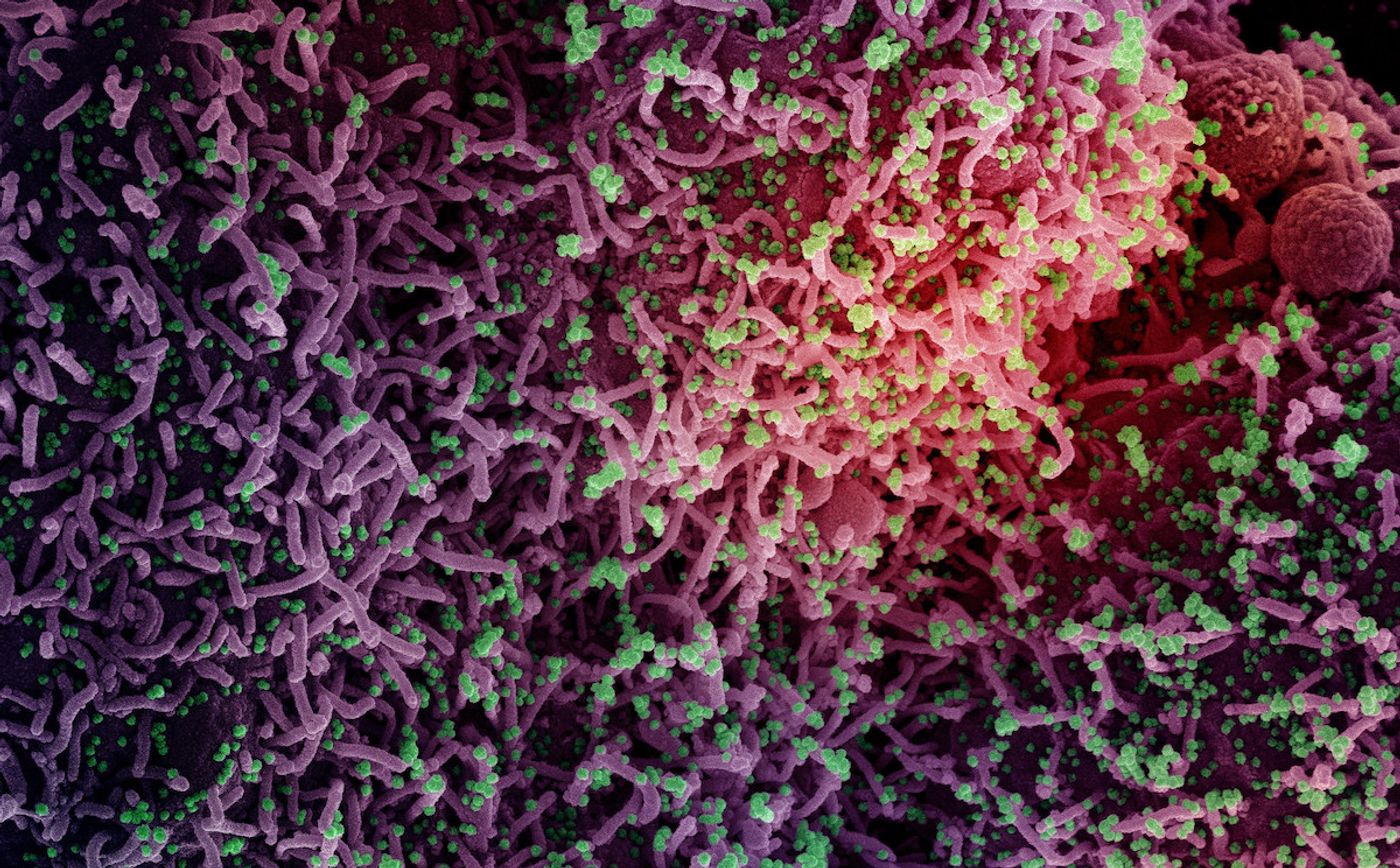 Colorized scanning electron micrograph of a cell infected with a variant strain of SARS-CoV-2 virus particles, isolated from a patient sample. Image captured at the NIAID Integrated Research Facility (IRF) in Fort Detrick, Maryland. Credit: NIAID