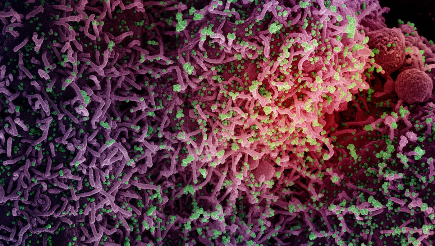 Colorized scanning electron micrograph of a cell infected with a variant strain of SARS-CoV-2 virus particles, isolated from a patient sample. Image captured at the NIAID Integrated Research Facility (IRF) in Fort Detrick, Maryland. Credit: NIAID