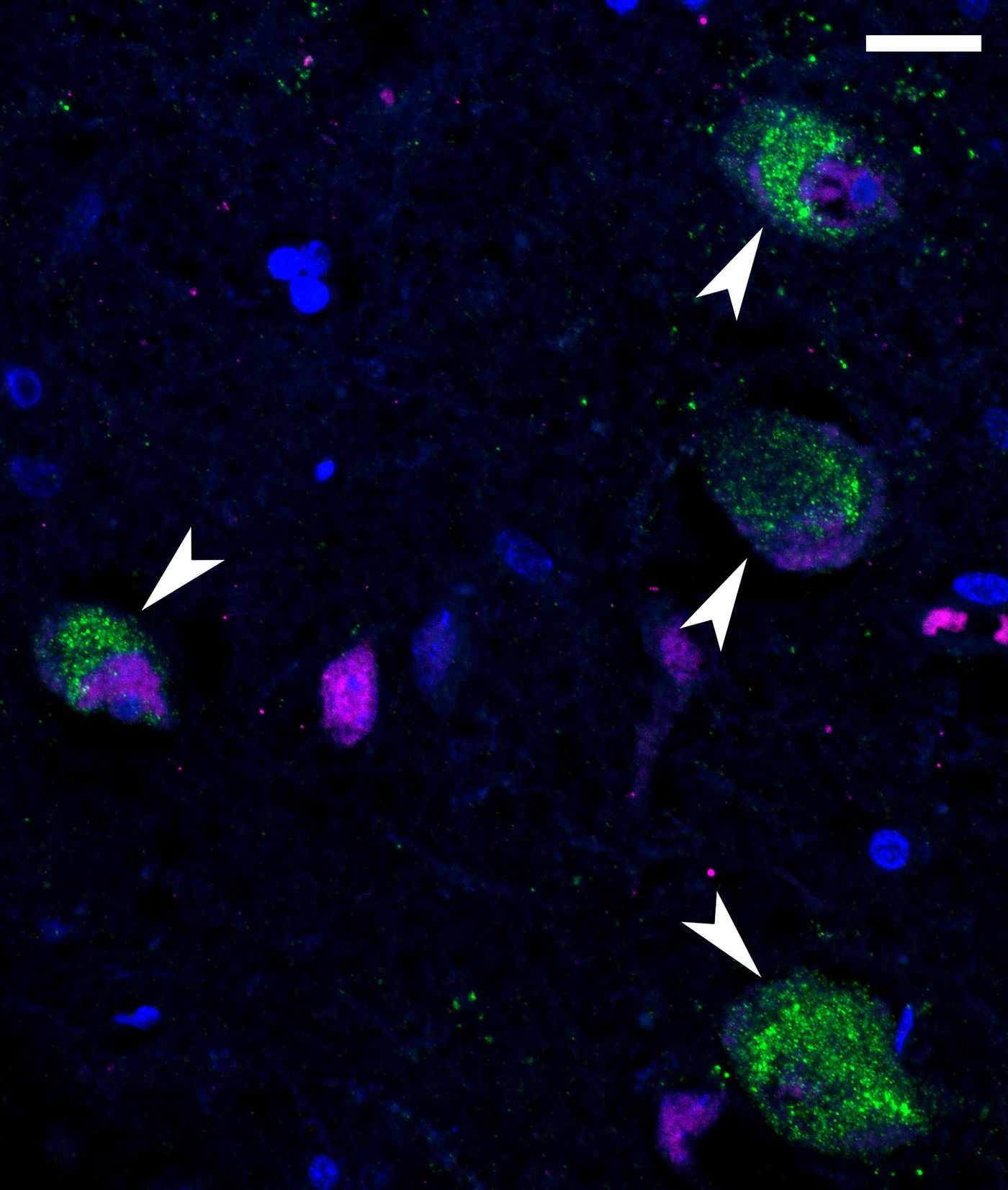 SARS-CoV-2 Components in Brain Neurons  Immunofluorescent image that shows SARS-CoV-2 components (green) specifically in neurons (magenta) in the hypothalamus of the brain of a person who died from COVID-19. Image captured and colorized at Rocky Mountain Laboratories in Hamilton, Montana. Credit: NIAID