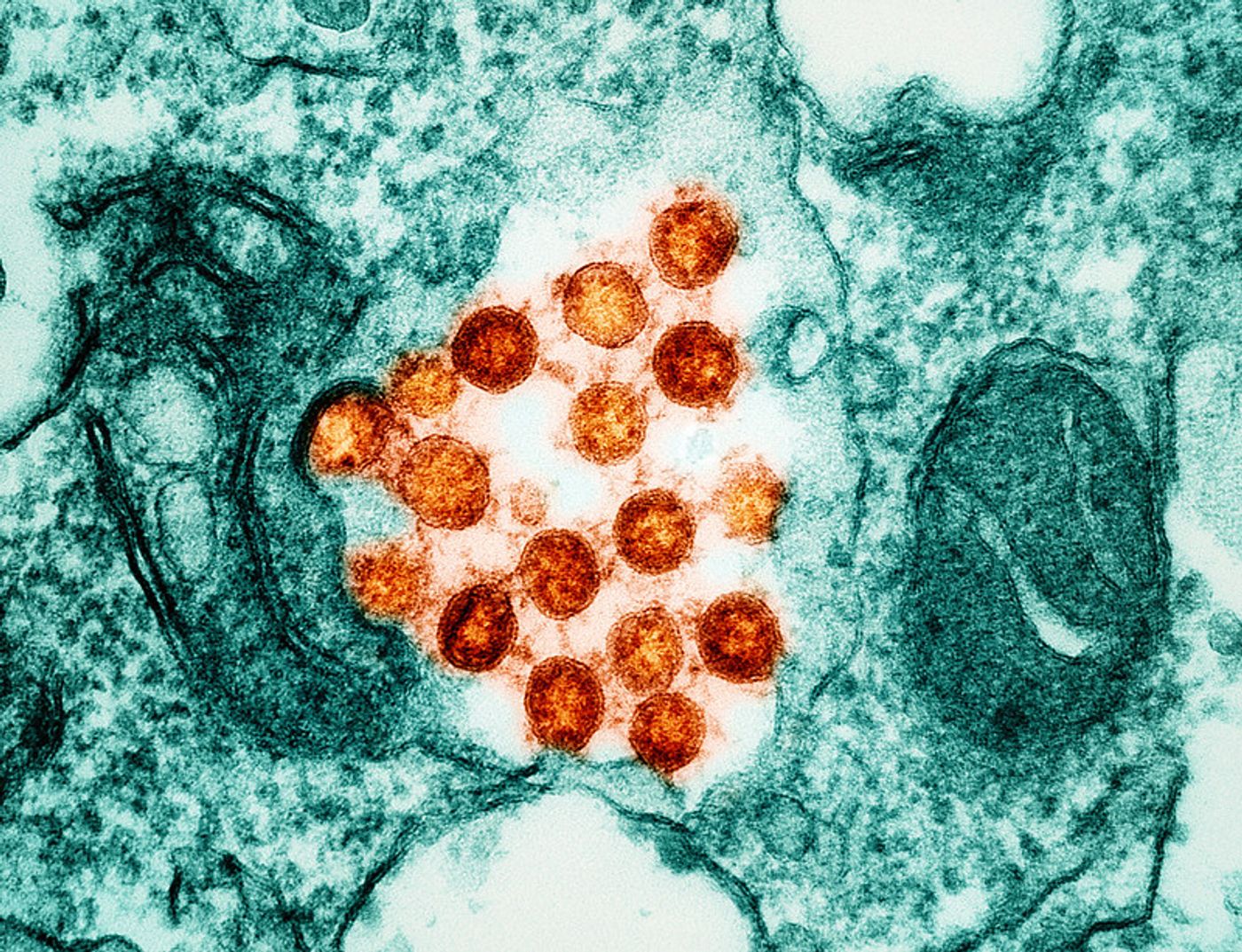 Transmission electron micrograph of SARS-CoV-2 virus particles (colorized orange), isolated from a patient. Image captured at the NIAID Integrated Research Facility (IRF) in Fort Detrick, Maryland. Credit: NIAID