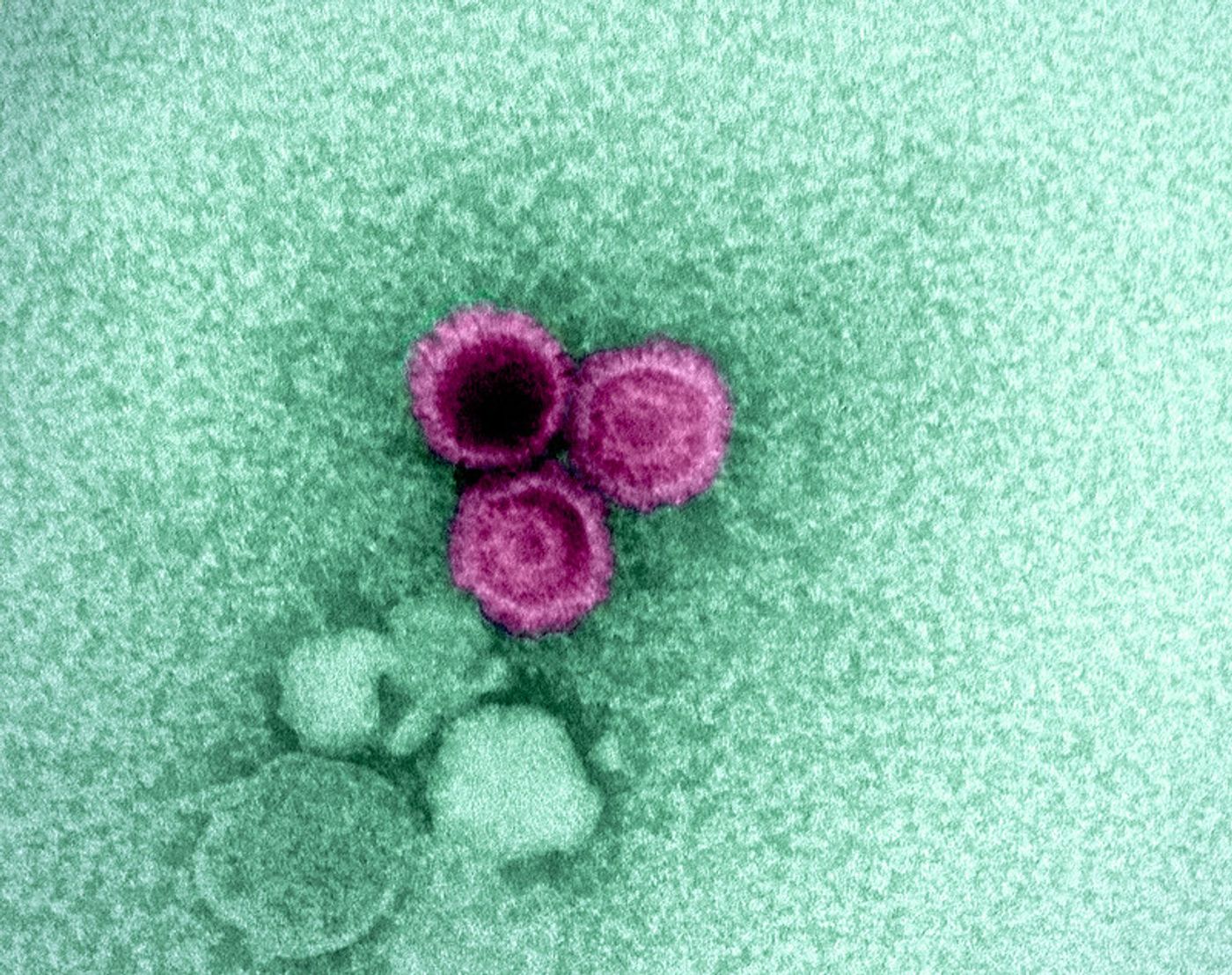 An electron micrograph showing three Epstein-Barr virus (EBV) particles colorized pink. Credit: NIAID