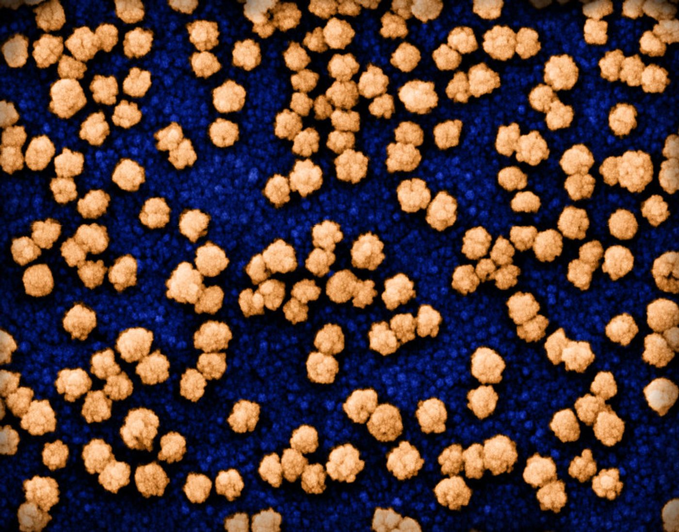 Colorized scanning electron micrograph of SARS-COV-2 particles (orange) on and budding from the surface of a heavily infected VERO E6 cell (blue). Image captured at the NIAID Integrated Research Facility (IRF) in Fort Detrick, Maryland. Credit: NIAID