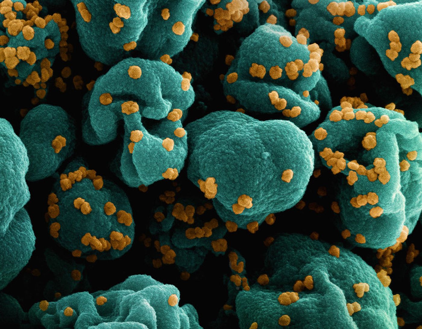 Colorized scanning electron micrograph of a cell (teal) infected with SARS-CoV-2 virus particles (orange), isolated from a patient sample. Image captured at the NIAID Integrated Research Facility (IRF) in Fort Detrick, Maryland. Credit: NIAID 