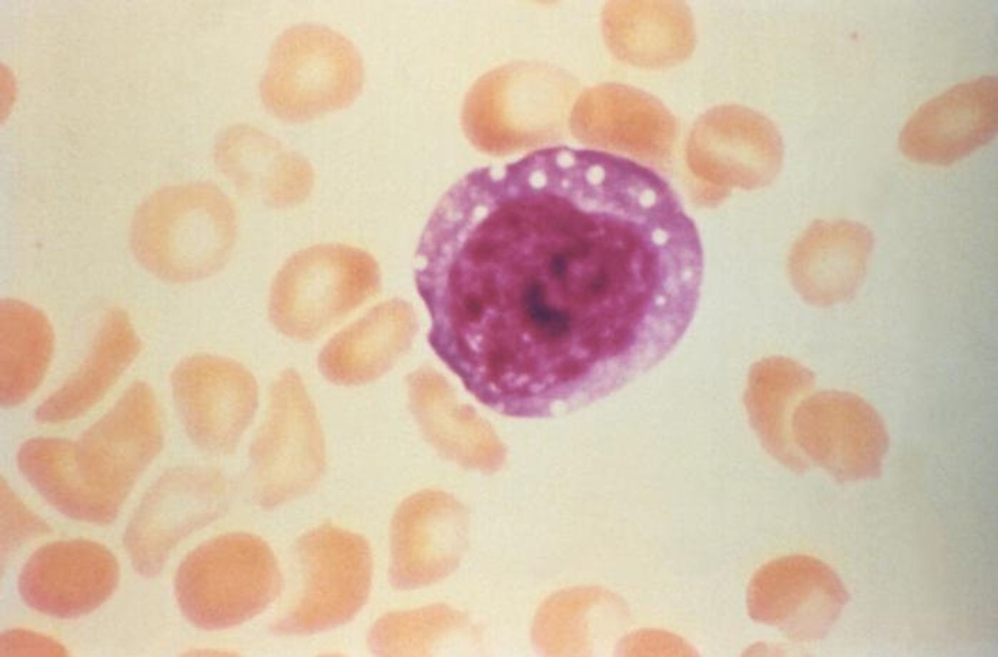 This micrograph depicts an atypical, enlarged lymphocyte found in the blood smear from a hantavirus pulmonary syndrome (HPS) patient. Hematologic findings are important in HPS. / Credit: CDC