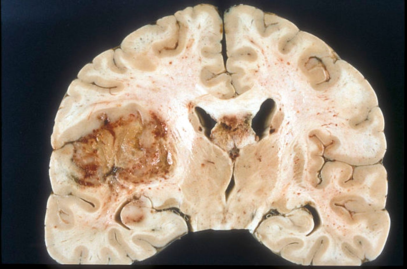 A glioblastoma tumor