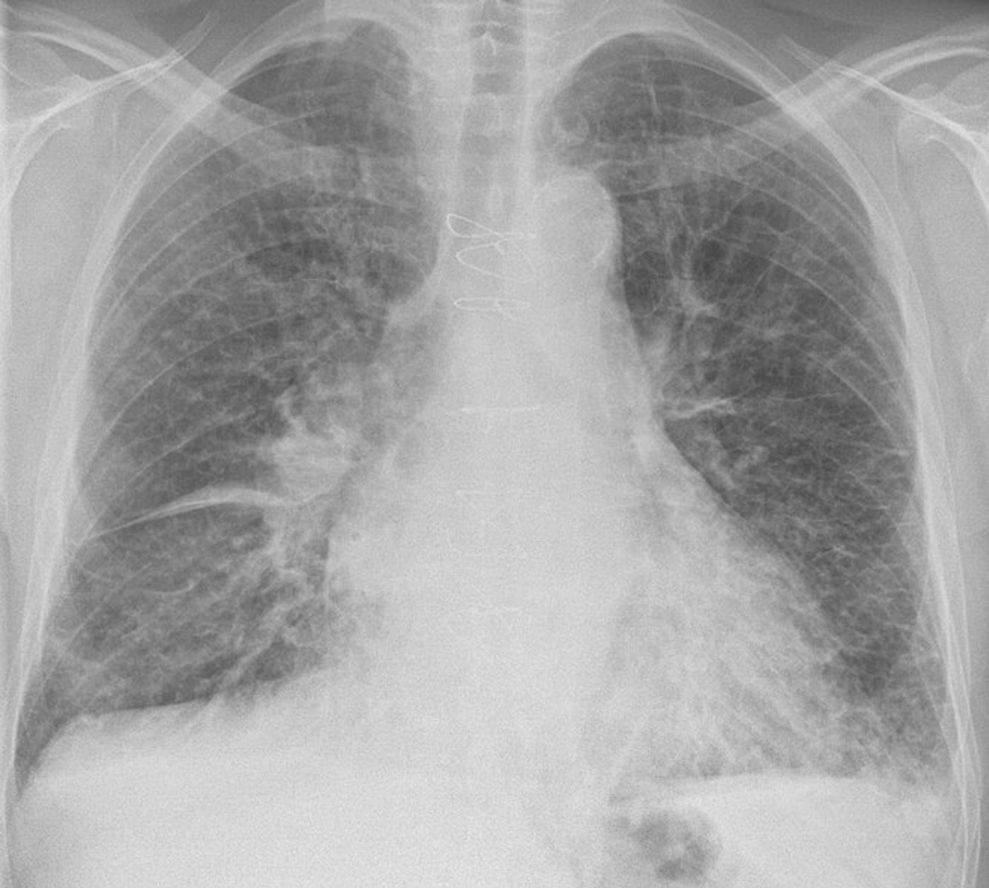 Chest radiograph of an 83 year old man with previous coronary artery bypass surgery indicating intermediate congestive heart failure.