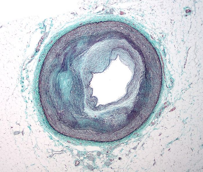Micrograph of a coronary artery with complex atherosclerosis and narrowing. Credit: Nephron