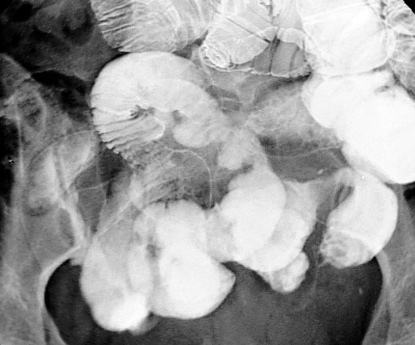  Fixed stenosis of the small intestine in Crohn's disease. Credit: Wikimedia user Hellerhoff