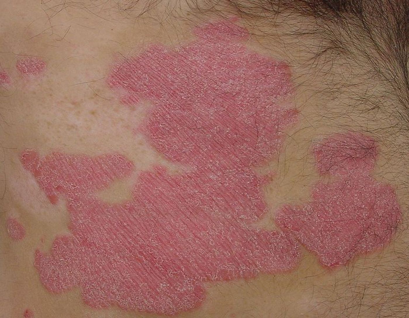 Characteristic patches of plaque psoriasis. Credit: Eisfelder