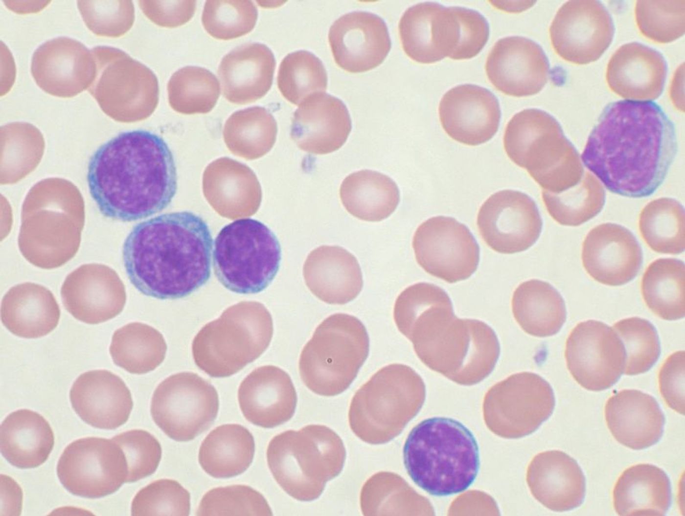 A Wright's stained peripheral blood smear showing chronic lymphocytic leukemia (CLL). The lymphocytes with the darkly staining nuclei and scant cytoplasm are the CLL cells.