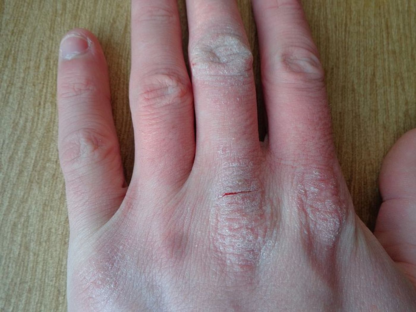 Atopic dermatitis. Credit: Wikimedia user AfroBrazilian.