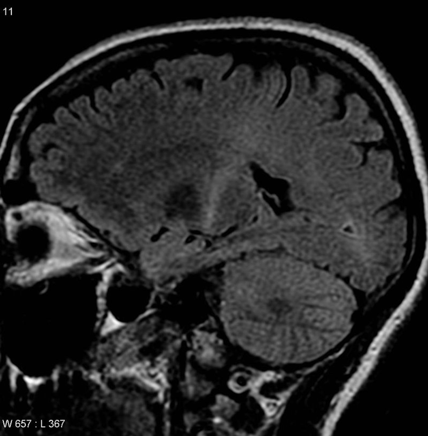 MRI of someone with amyotrophic lateral sclerosis. Credit: Dr. Frank Gaillard