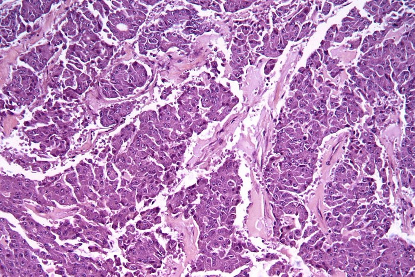 High magnification micrograph of a acinar cell carcinoma of the pancreas. Credit: Wikimedia user Nephron
