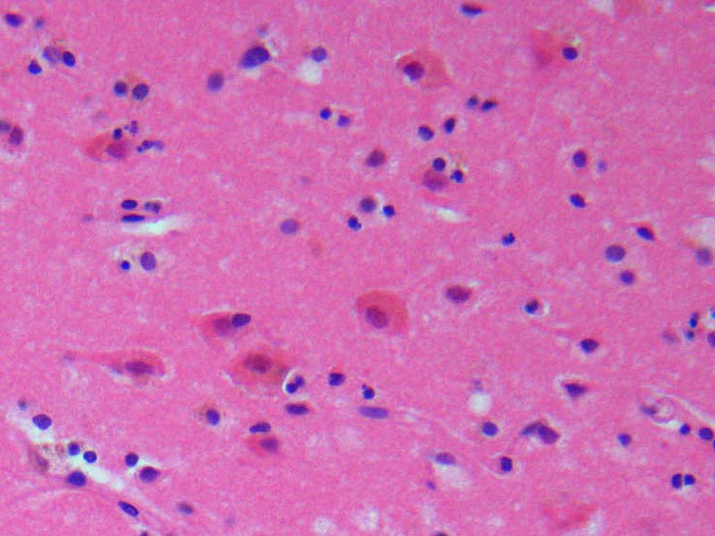 Microphotograph of human brain tissue upon acute ischemic stroke. Credit: Martin Hasselblatt, MD