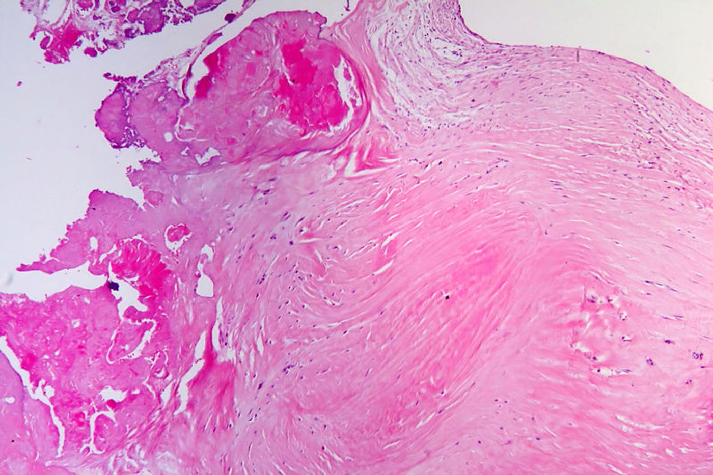 Aortic valve shows extensive fibrosis. Credit: Wikimedia User Patho