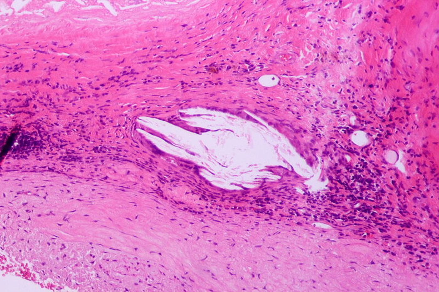 Histopathology of atherosclerosis. Credit: Wikimedia User Pathos