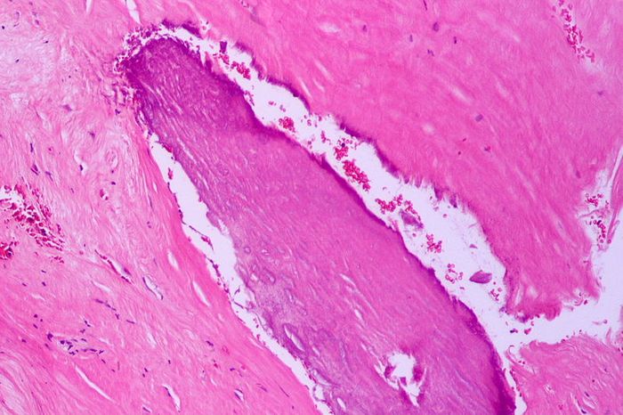 Cross-section of atherosclerotic tissue. Source: Patho