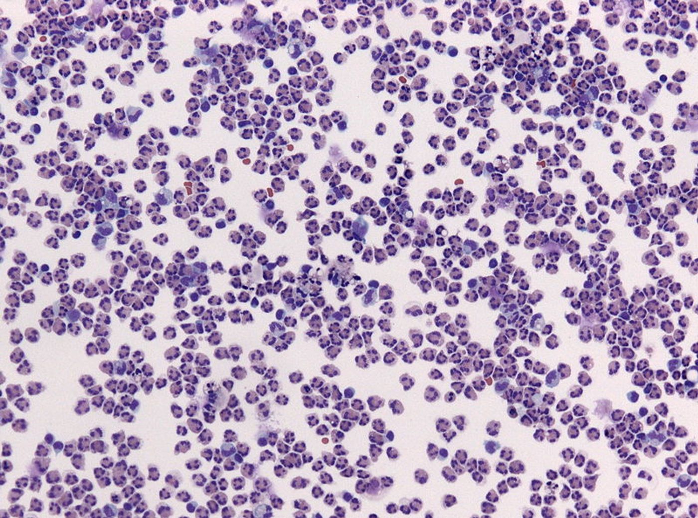 Cerebrospinal fluid specimen with numerous neutrophils indicating meningitis. Credit: Jensflorian