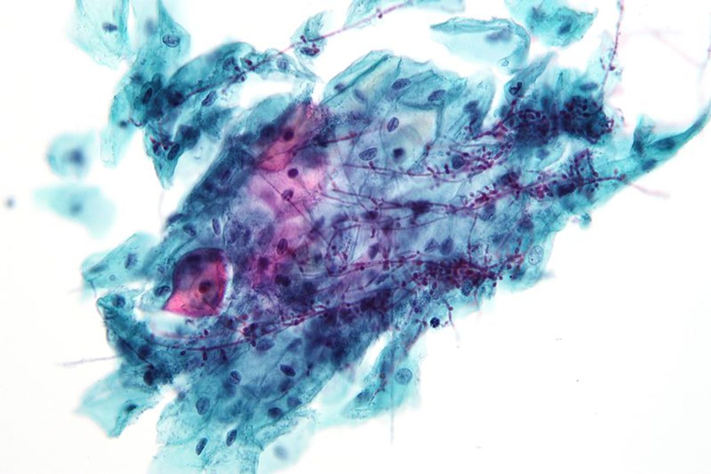 Micrograph showing candida. Credit: Wikimedia user Nephron