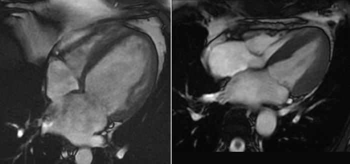 Human heart with dilated cardiomyopathy (left) and normal heart (right), shown in cardiac MRI.