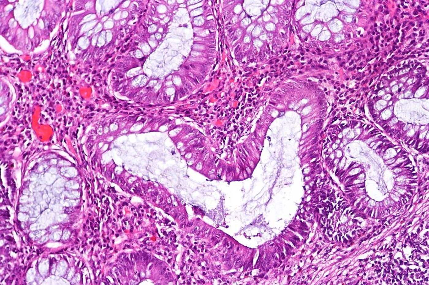 Histopathology image of chronic inactive ulcerative colitis. Credit: CoRus13