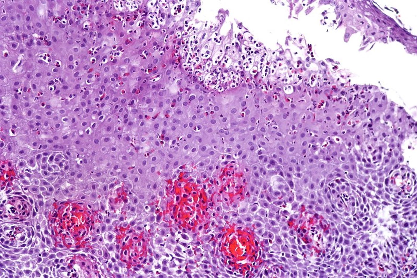 Eosinophilic esophagitis with prominent eosinophils within the epithelial tissue. Credit: CoRus13