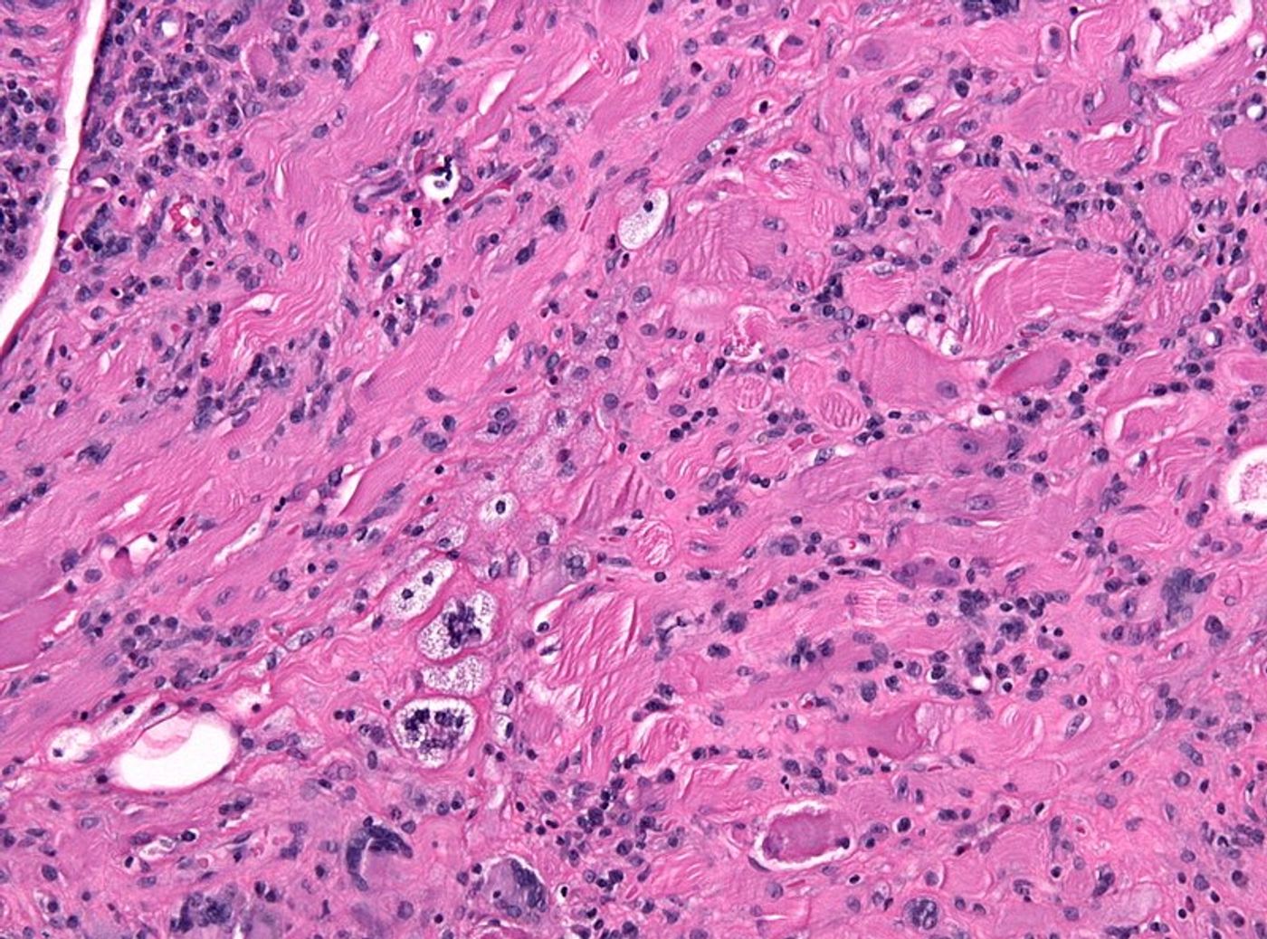 Histology section from rheumatoid arthritis tissue, showing inflammation and joint damage. Credit: Jensflorian
