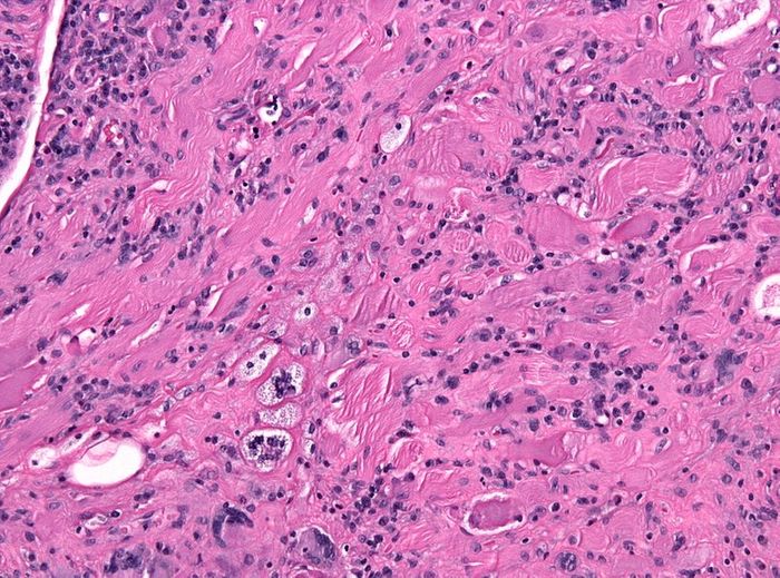 Autoantibody Detection for Rheumatoid Arthritis Patients Immunology