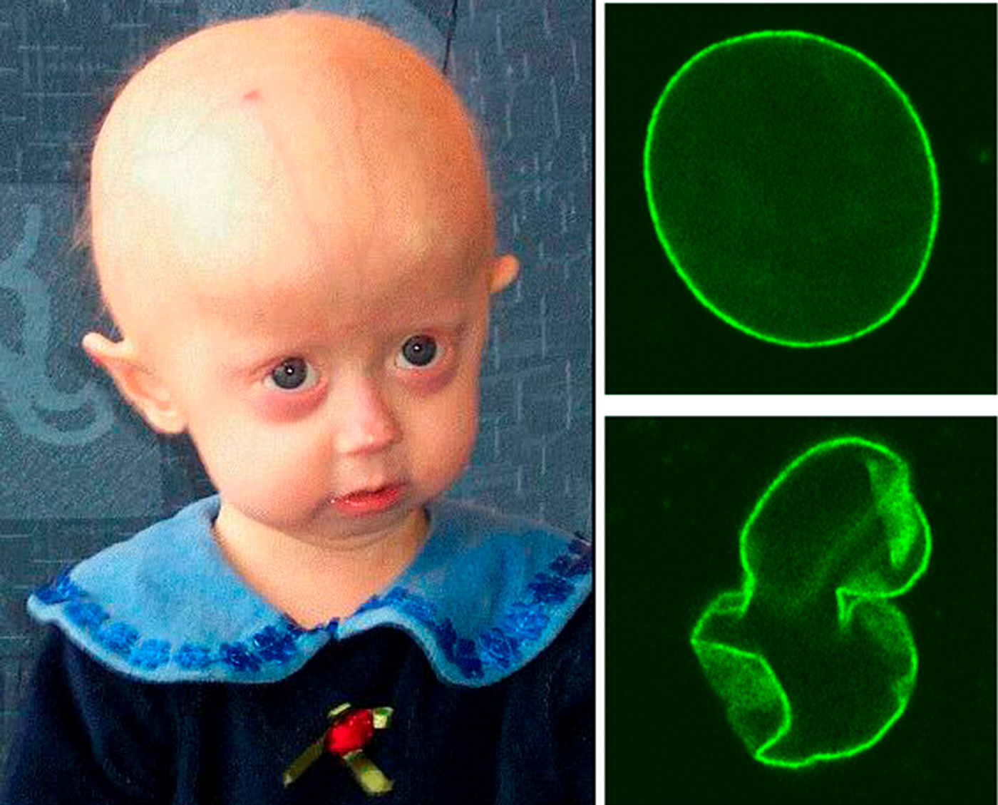 HGPS is a childhood disorder caused by mutations in one of the major architectural proteins of the cell nucleus. In HGPS patients the cell nucleus has dramatically aberrant morphology (bottom, right) rather than the uniform shape typically found in healthy individuals (top, right). Source: The Cell Nucleus and Aging: Tantalizing Clues and Hopeful Promises. Scaffidi P, Gordon L, Misteli T. PLoS Biology Vol. 3/11/2005, e395