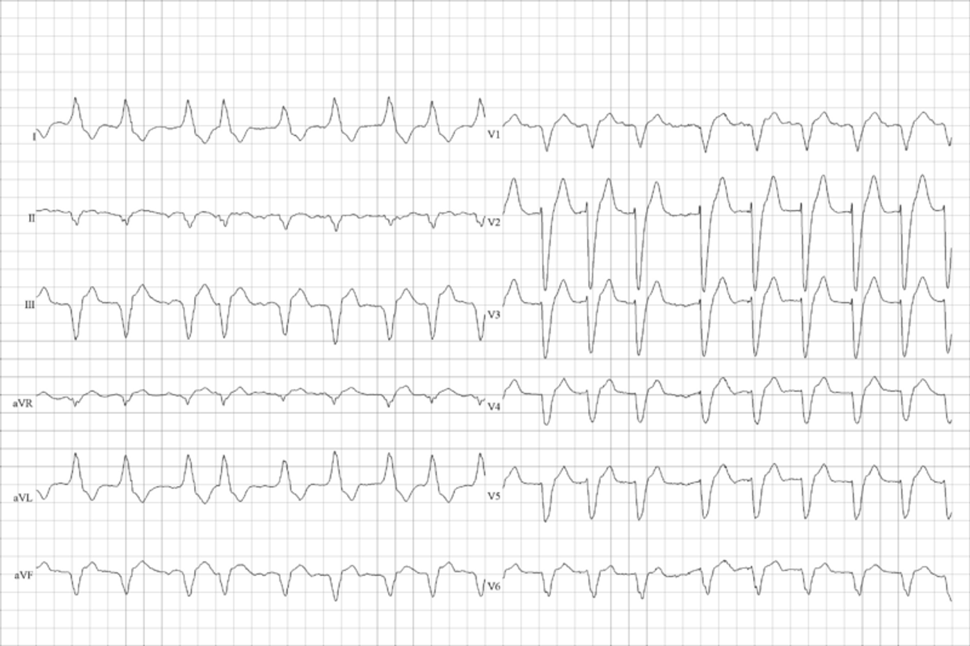 ECG showing left bundle branch block and atrial fibrillation. Credit: Steven Fruitsmaak