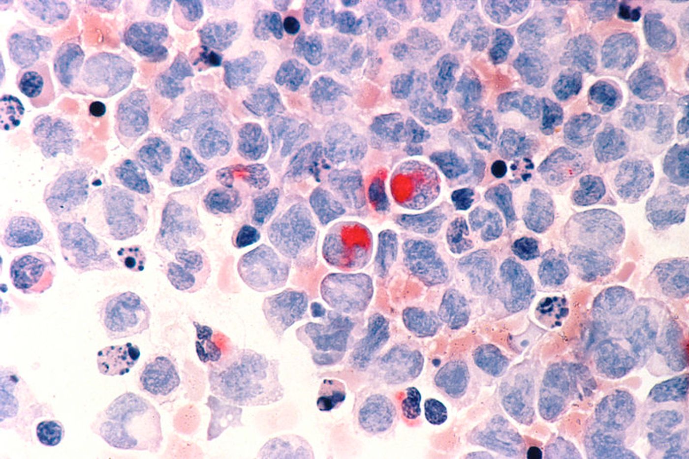 Human cells with acute myelocytic leukemia (AML). Credit: National Cancer Institute