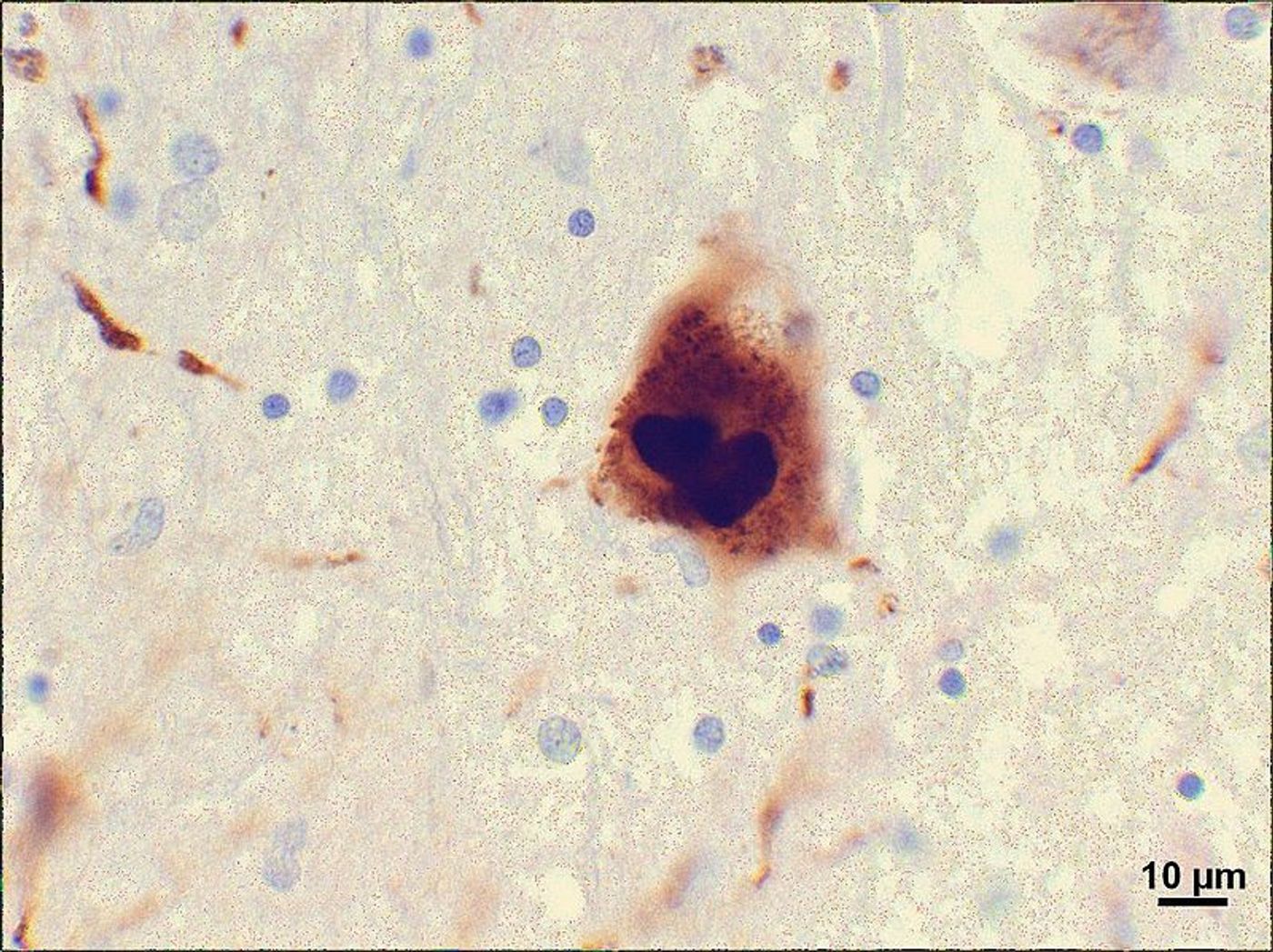 Photomicrograph of a region of substantia nigra in a Parkinson's patient showing Lewy bodies and Lewy neurites. Credit: Suraj Rajan