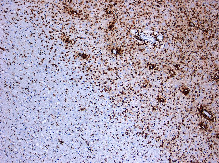 Photomicrograph of a demyelinating MS-Lesion. Immunohistochemical staining for CD68 highlights numerous macrophages (brown). Credit: Marvin 101