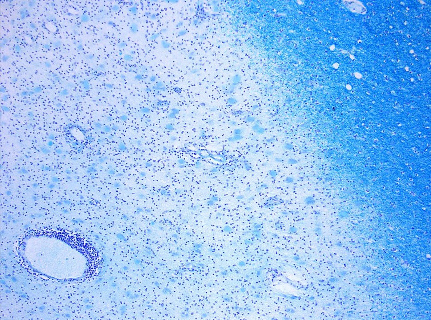 Photomicrograph of a demyelinating MS-Lesion. Credit: Wikimedia user Marvin 101