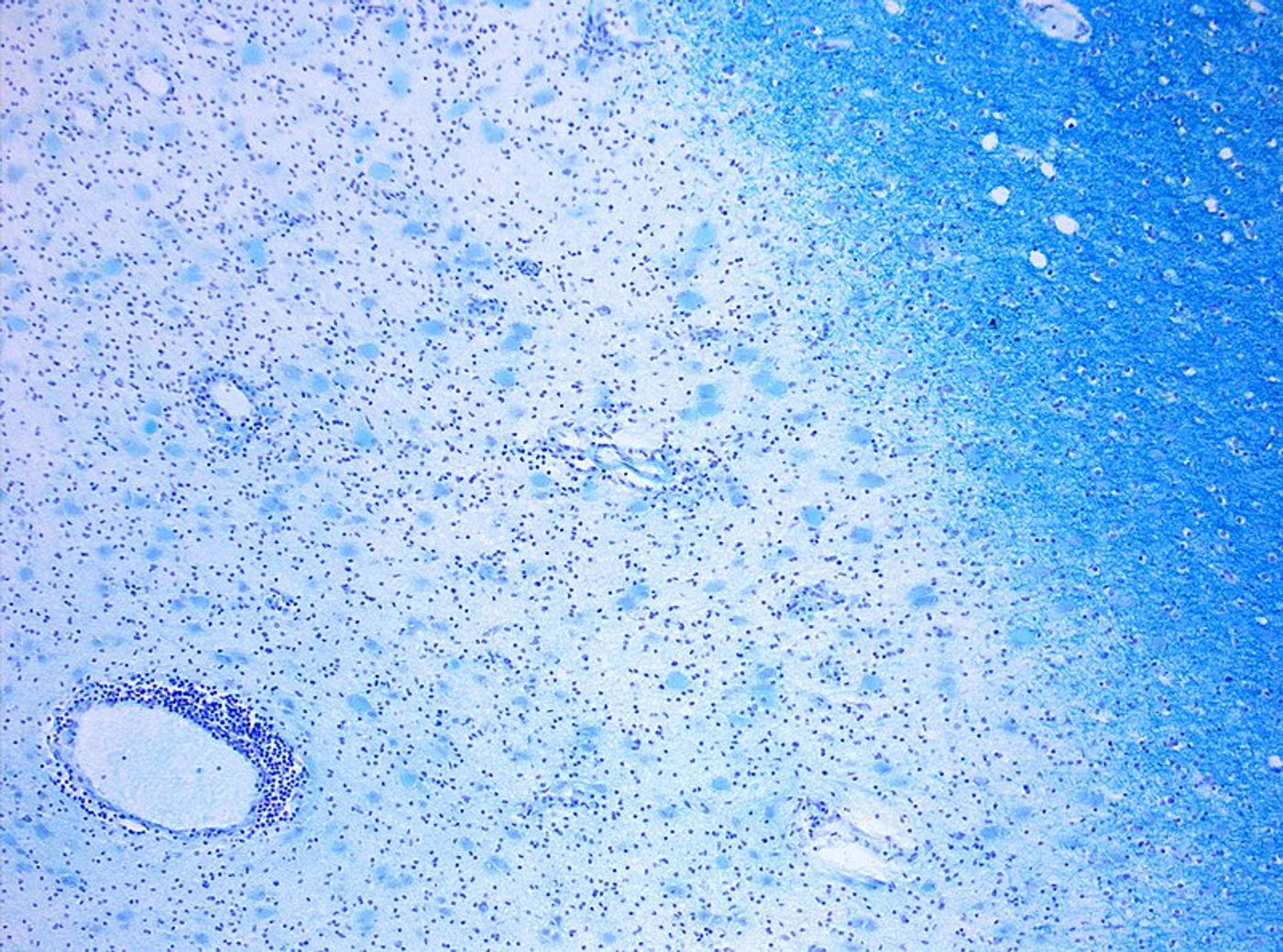 Photomicrograph of a demyelinating MS-Lesion. Credit: Wikimedia user Marvin 101