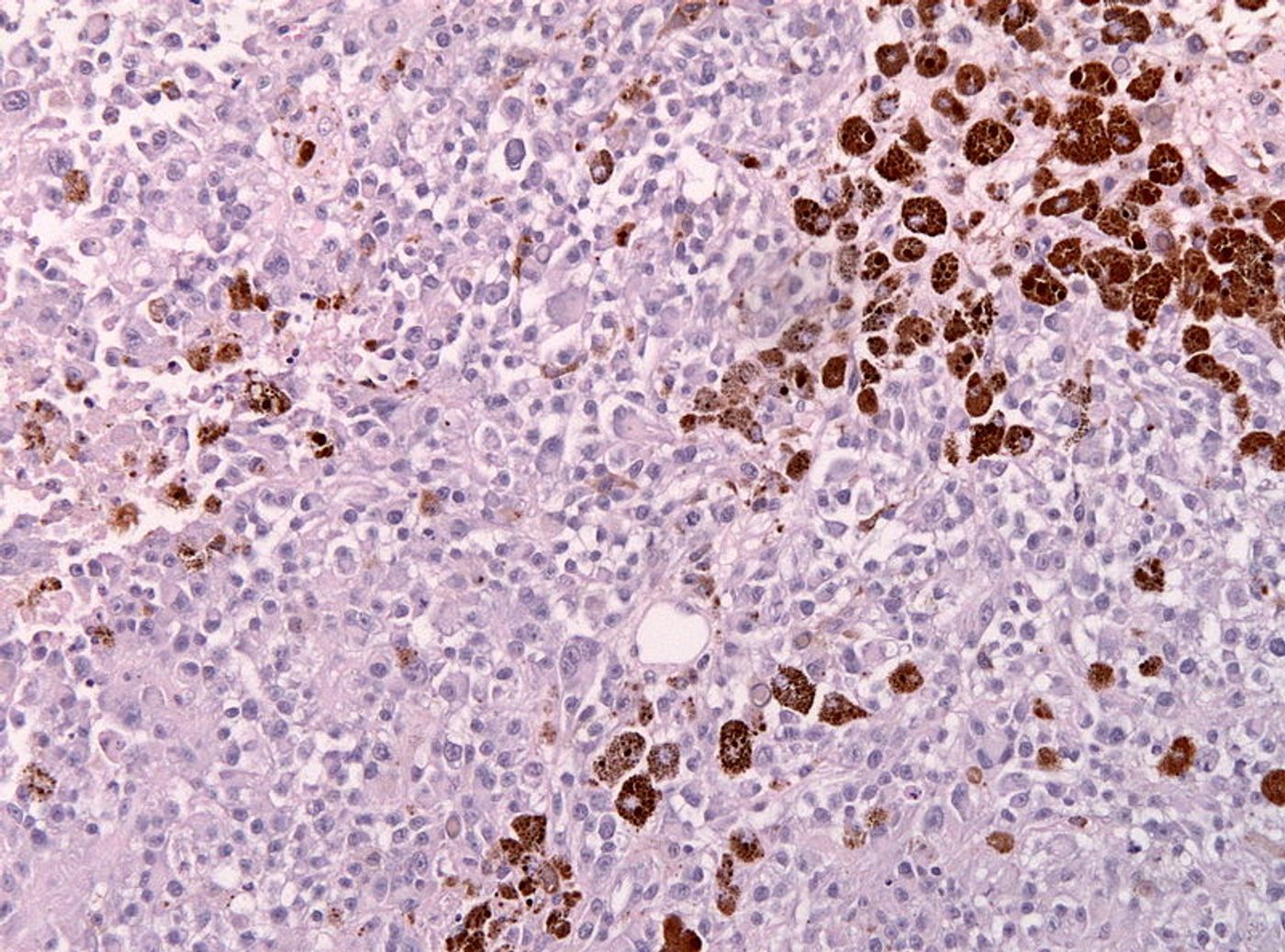 Pigmented cells of a malignant melanoma metastasis. Credit: Wikimedia user Jensflorian